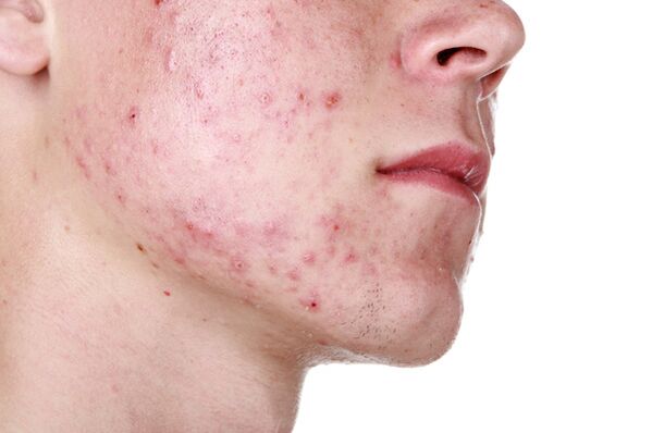 Лезии на кожата на лицето со демодикоза